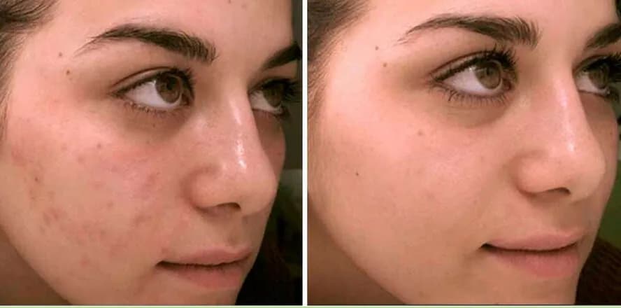 Limpieza facial antes y después: transforma tu piel visiblemente