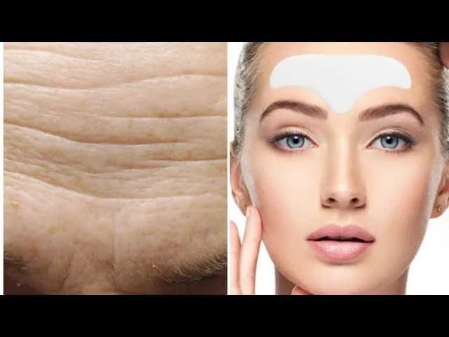 Parches antiarrugas frente: elimina las líneas de expresión fácilmente